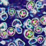 É assim que o sarampo mata