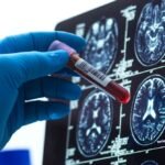Os exames de sangue para Alzheimer estão aqui