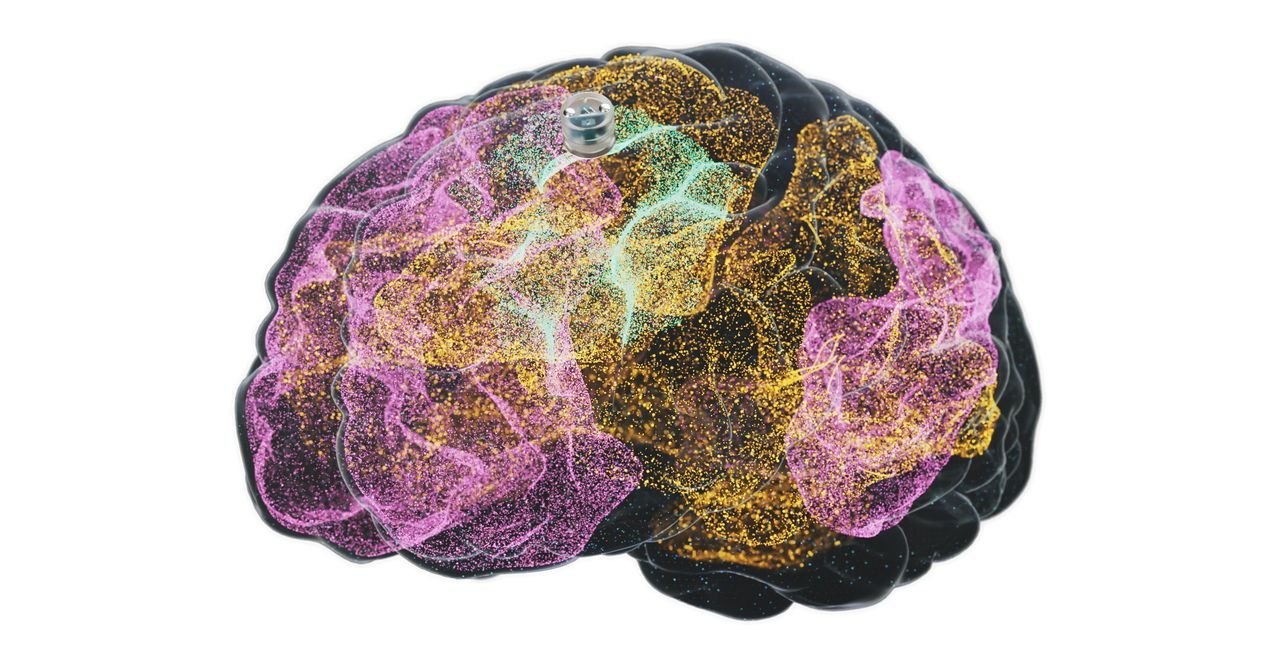 Um implante cerebral para depressão está prestes a ser testado em humanos